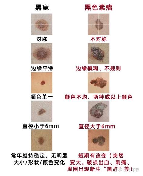 黑痣凸起|这样的黑痣竟是“黑色素瘤”！医生：超过这个尺寸的黑。